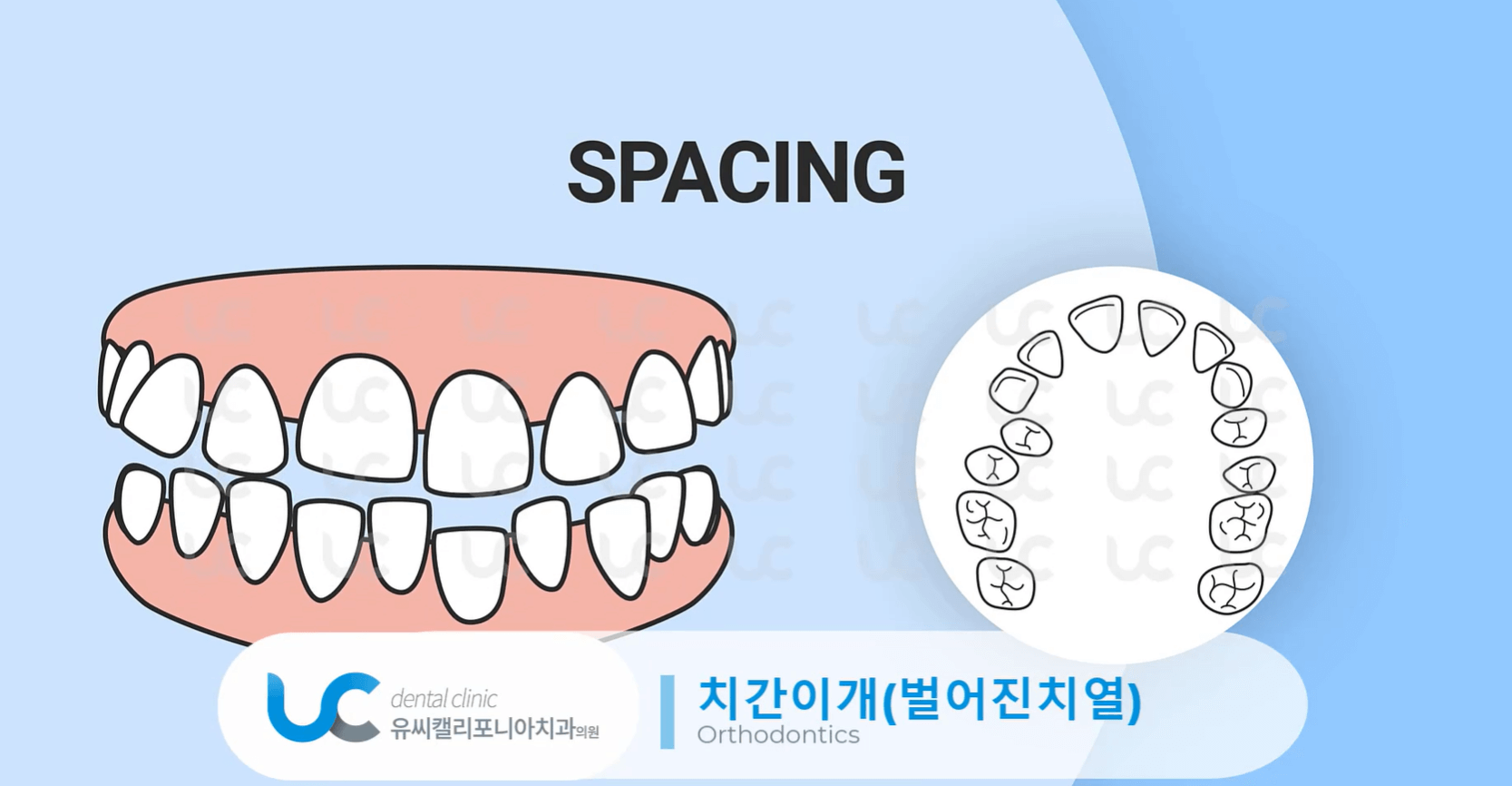 과개교합-치료-안하면