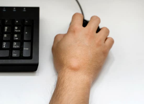 손등/손바닥 결절종(Ganglion Cyst) – 원인부터 치료까지 완벽 가이드