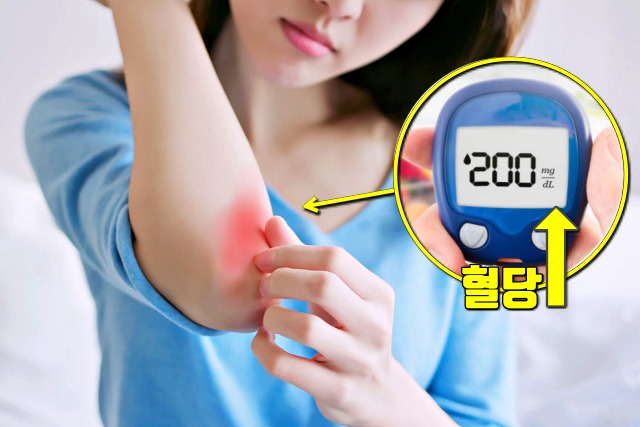 당뇨 전조 증상,당뇨 전단계 증상,피부 가려움증