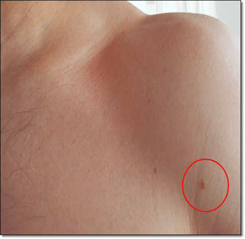 쥐젖 발생 부위, 겨드랑이