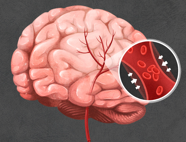 뇌경색 초기증상