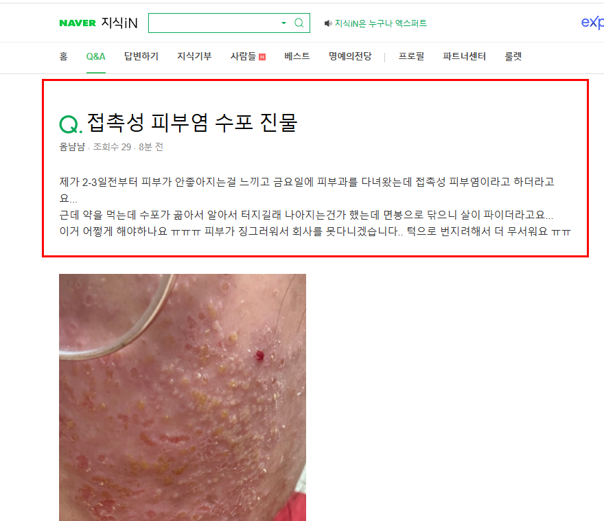 접촉성 피부염 질문