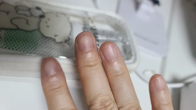 손톱에 생긴 새로 줄무늬