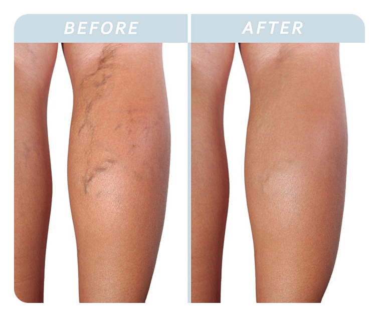 하지정맥류 증상과 수술, 그리고 수술 후 관리에 대하여