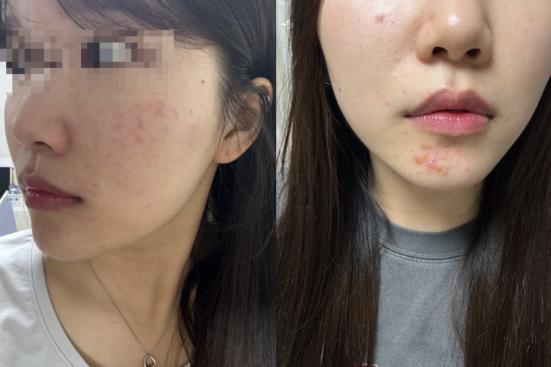 피부 뒤집어진 이유