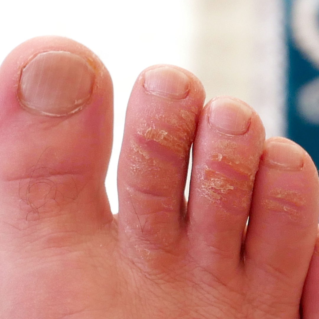 티눈과 굳은살 차이와 치료법&amp;#44; 발바닥 혹 없애는 법