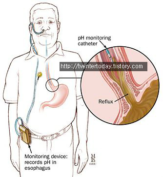 배명진 코 장치