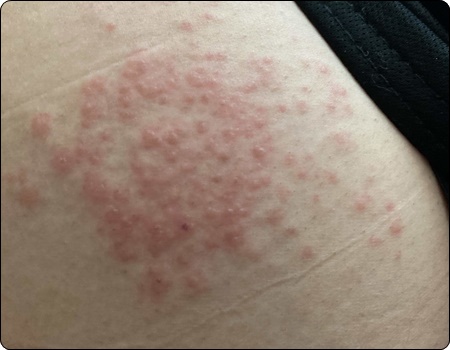 대상포진 예방접종 가격