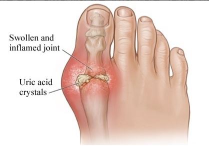 통풍 빨리 낫는 방법