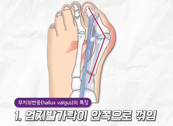 무지외반증1