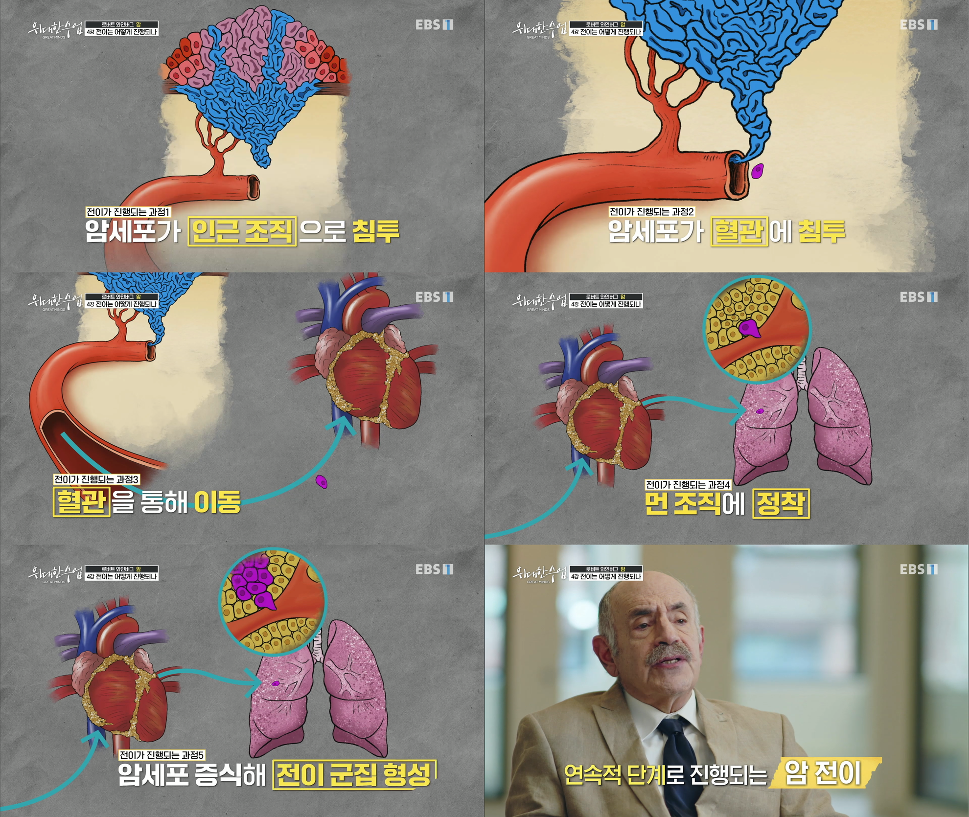 암 전이의 단계