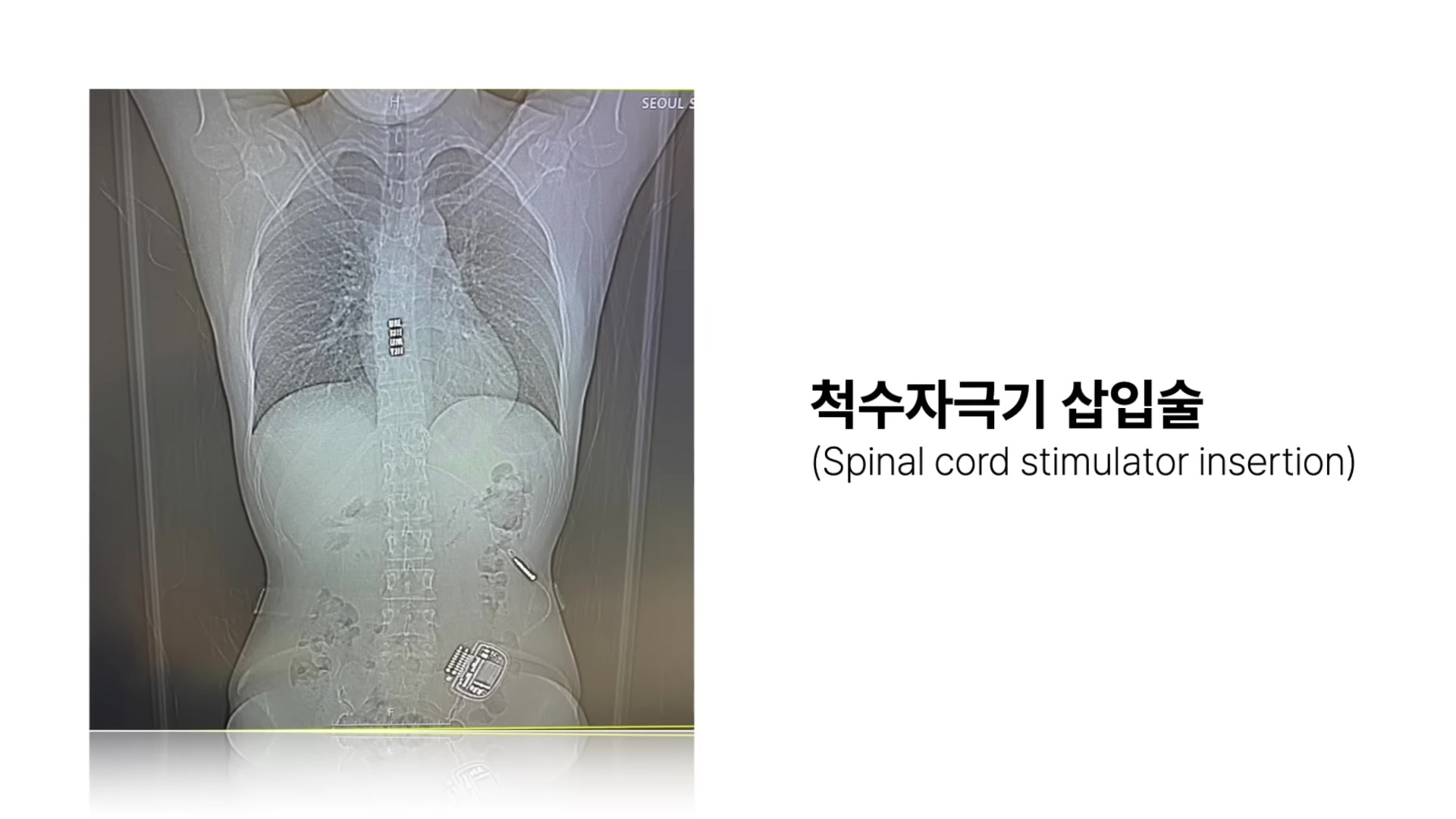 척수자극기 삽입술