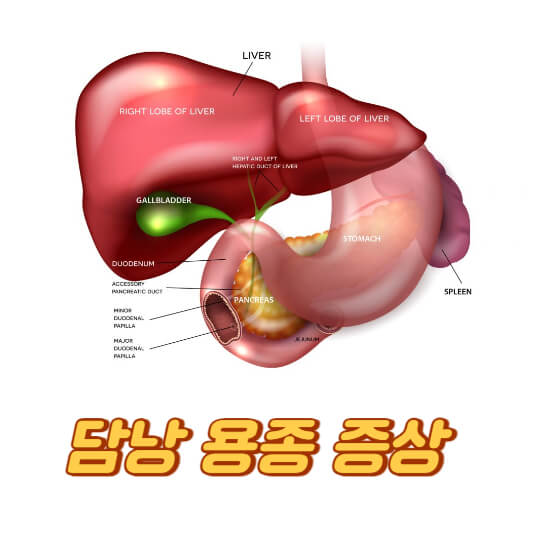 담낭 용종 증상