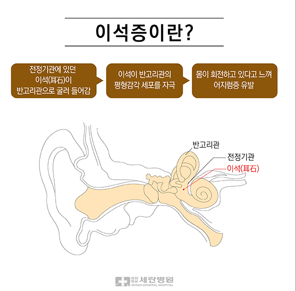 이석증 원인