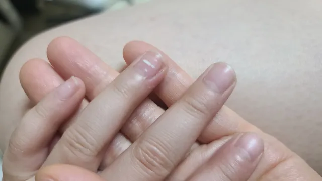 손톱에 흰색점과 하얀 줄무늬가 생겼어요.