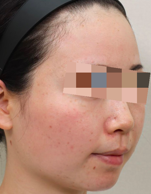 동안 얼굴 만들기 논현동 여드름 피부과