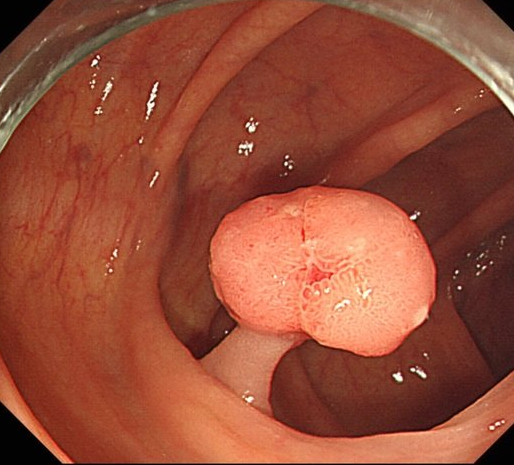 대장암 원인과 예방