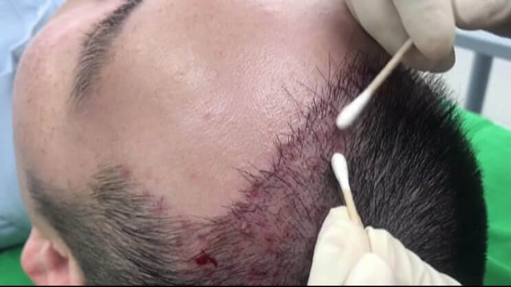 모발이식 3000모 비용, 부작용 정리