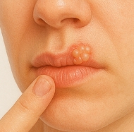 입술에 물집이 생기는 이유