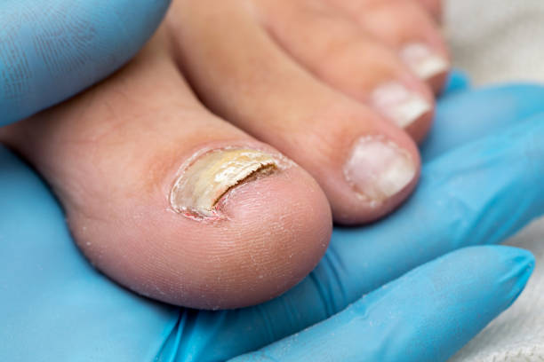 손톱 발톱 젤네일 손상 조갑박리증 원인 치료 법