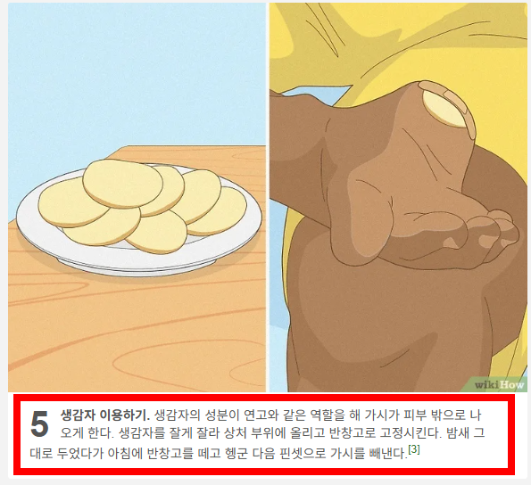 손가락 가시 빼는법 소개