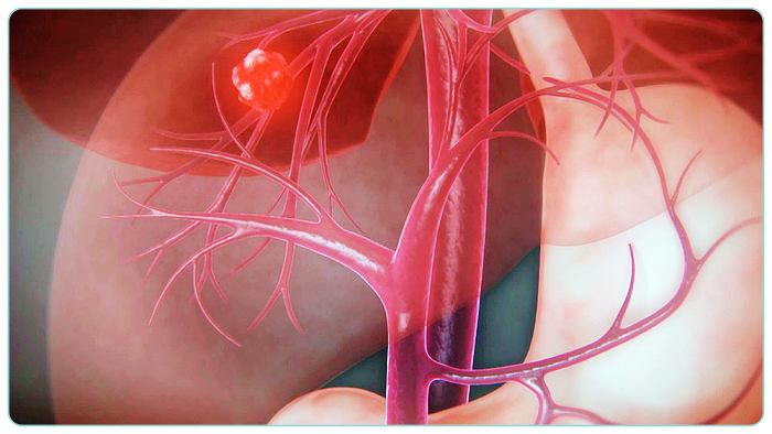 제731화-EBS-명의-간암-모습