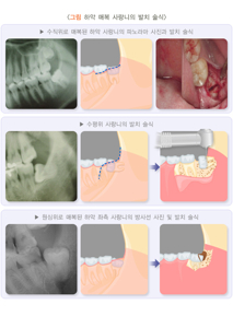 사랑니 발치 후 식사 가이드