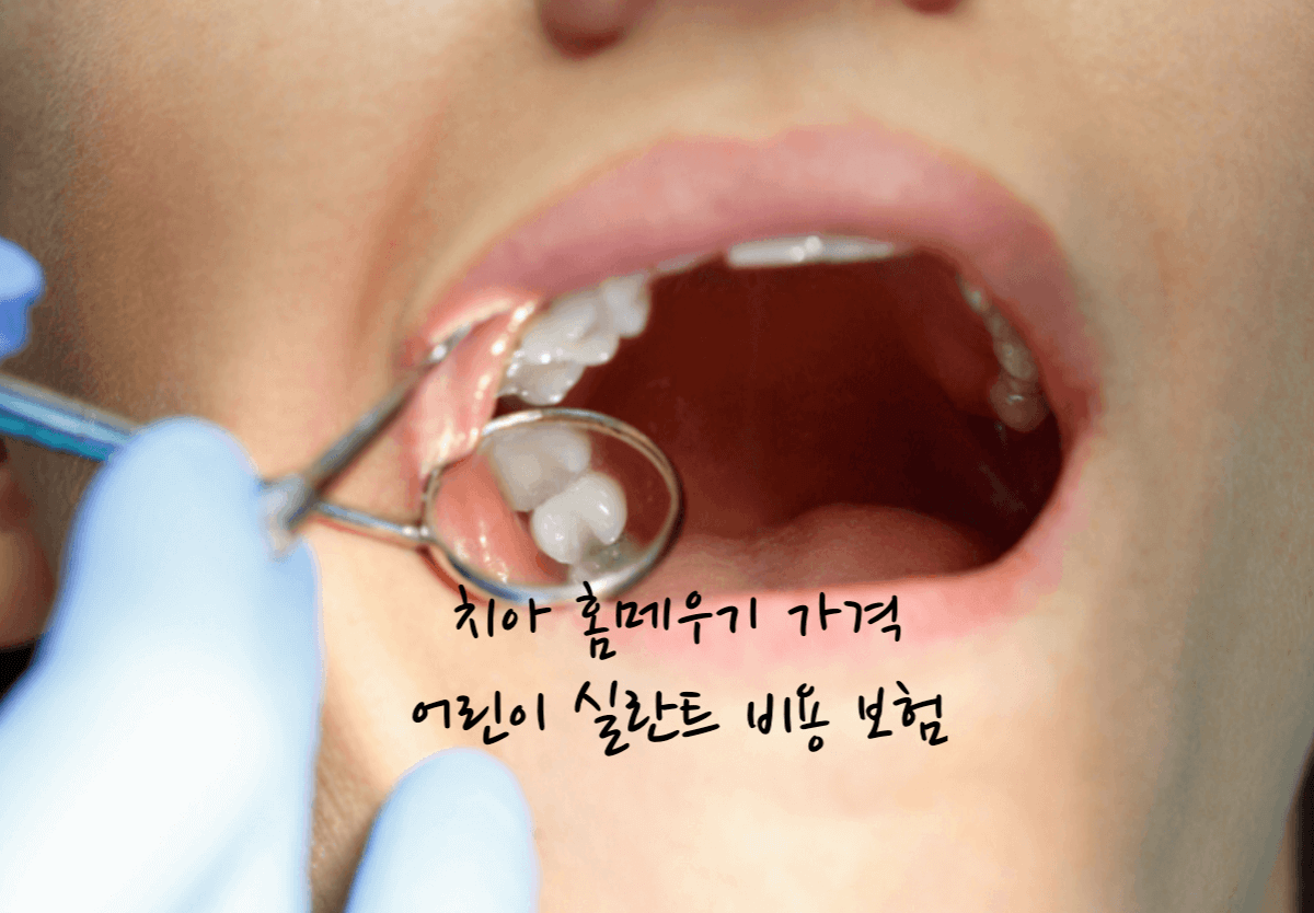 치아 홈메우기