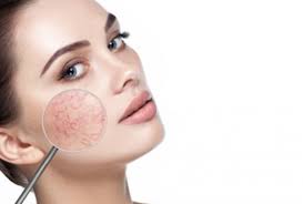 지루성 피부염 완치하려면