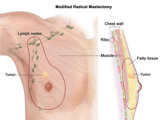 유방암 치료 : 최신 치료법과 효과적인 관리 전략