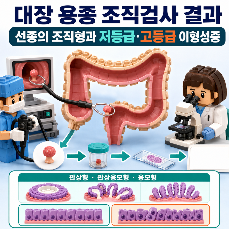대장 용종 조직검사 결과에서 선종의 조직형과 저등급&middot;고등급 이형성증을 설명하는 블록형 인포그래픽