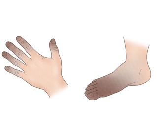 수족냉증에 좋은 음식