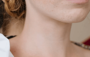 목주름 없애는 법