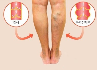 하지정맥류 치료과정