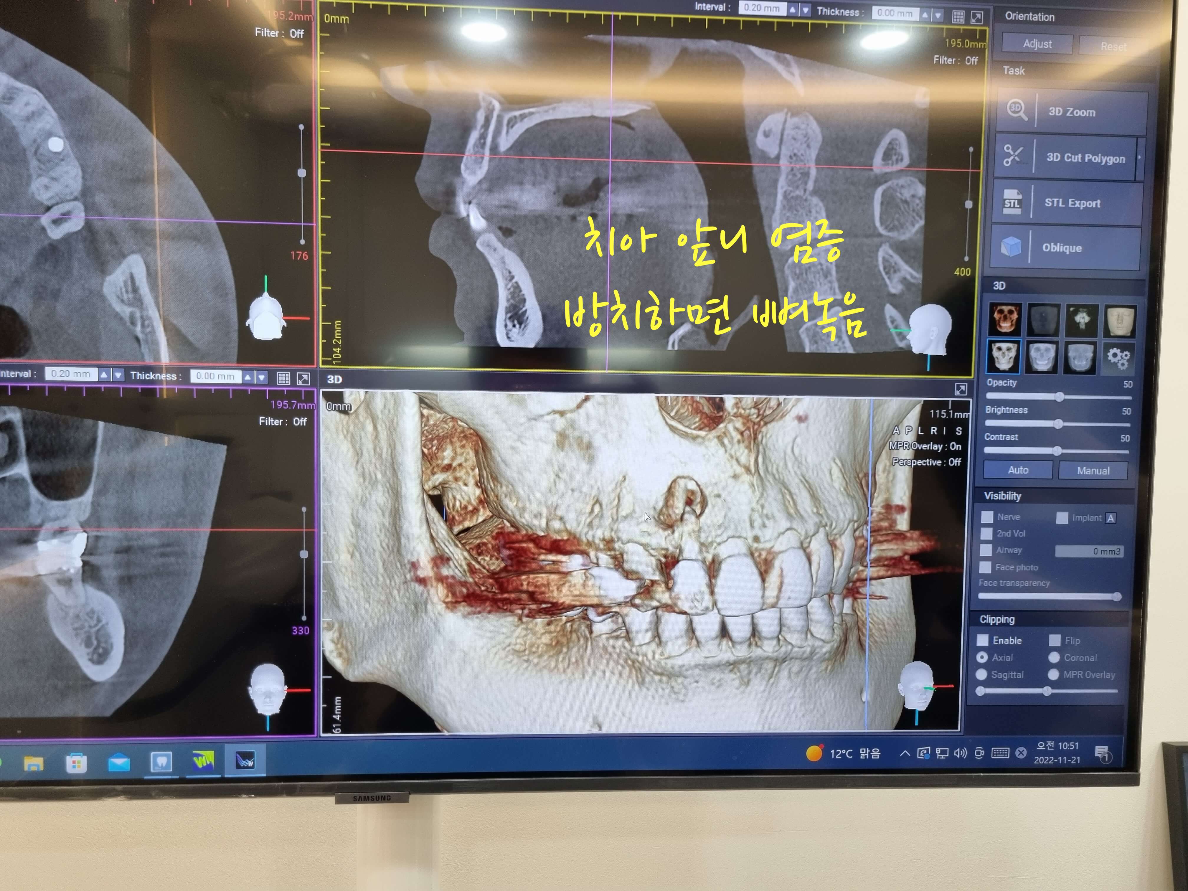 치아 앞니 염증