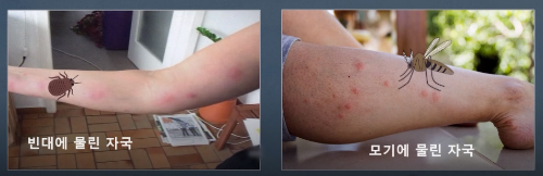알트태그-빈대에 물린 자국과 모기에 물린 자국 비교