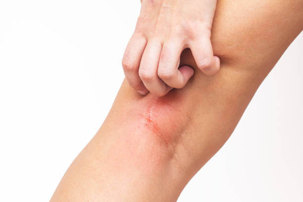 갑자기 생긴 허벅지 두드러기, 그 원인과 대처법은?