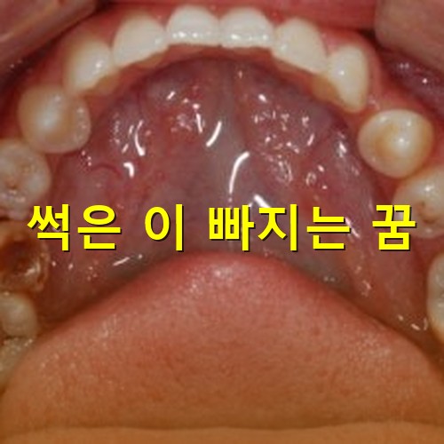 치아가-고른-사람이-입을-크게벌리며-치과-치료를-받는-모습