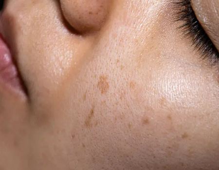 갱년기 이후 발생하는 기미, 검버섯, 도미나 크림으로 발라보니 2달 소요