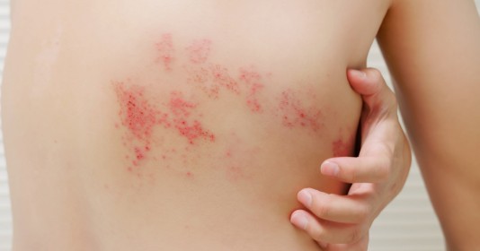 대상포진의 정의, 원인, 증상, 진단/검사, 치료, 경과/합병증, 예방방법