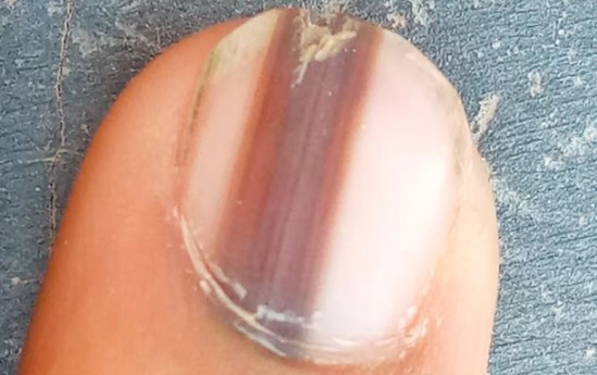 손톱 검은세로줄 원인 5가지