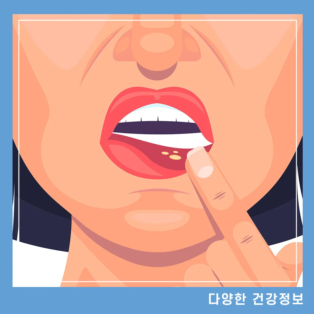 입술 헤르페스 포진
