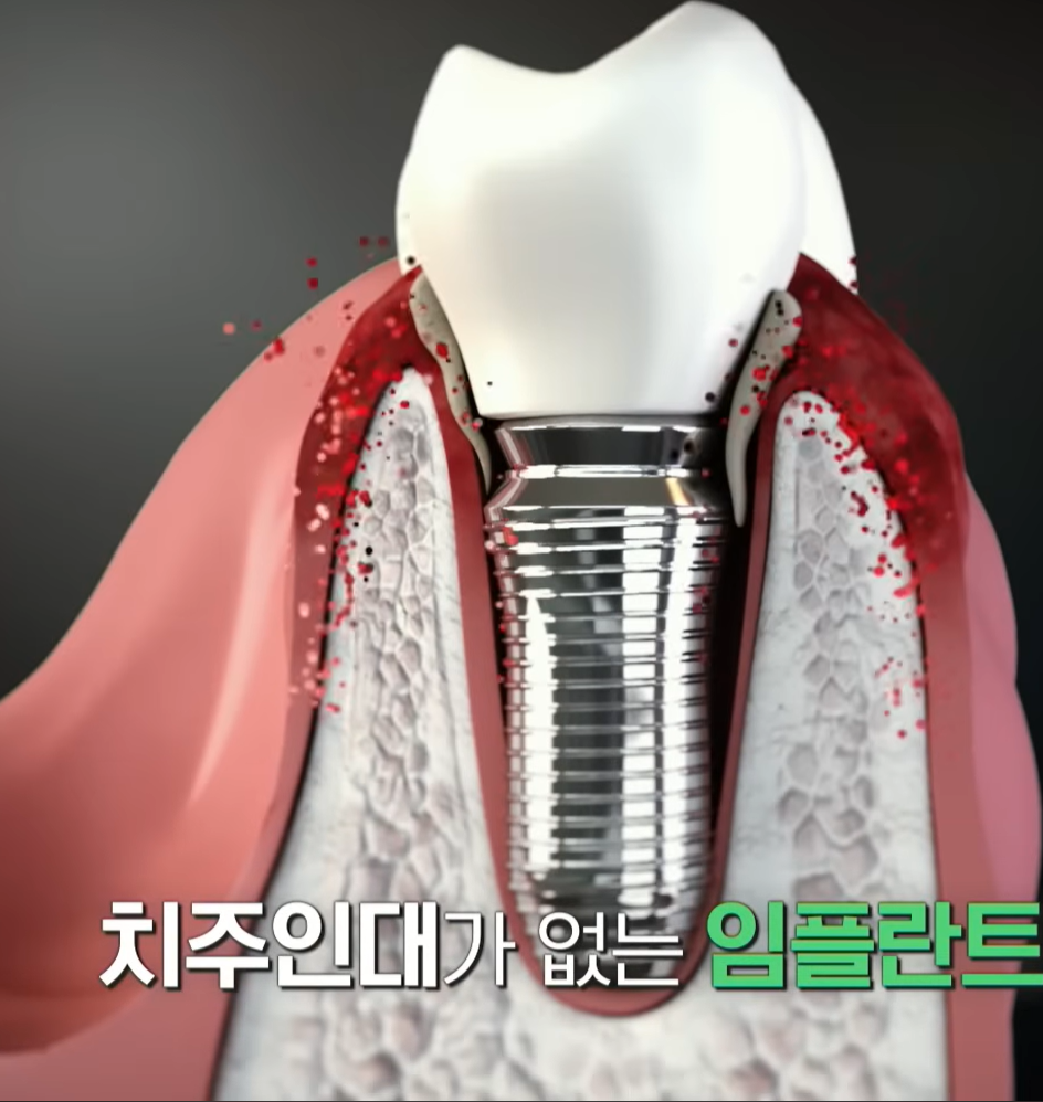 치주 인대가 없는 임플란트