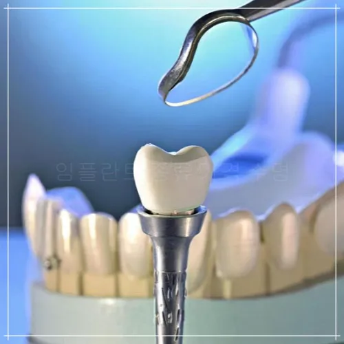 디지털 임플란트: 특징, 비용, 수명3
