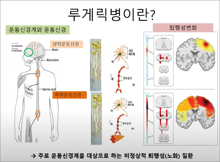 루게릭병