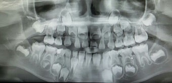치아·잇몸병 세균과의 전쟁