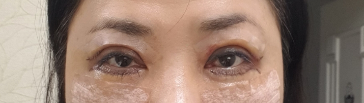 하안검 수술 후기