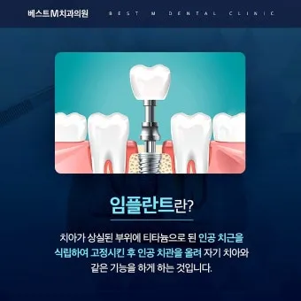 임플란트 지원 대상 건강보험 적용 연령 비용 안내_17
