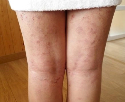 아토피 가려움증 해소방법 11가지