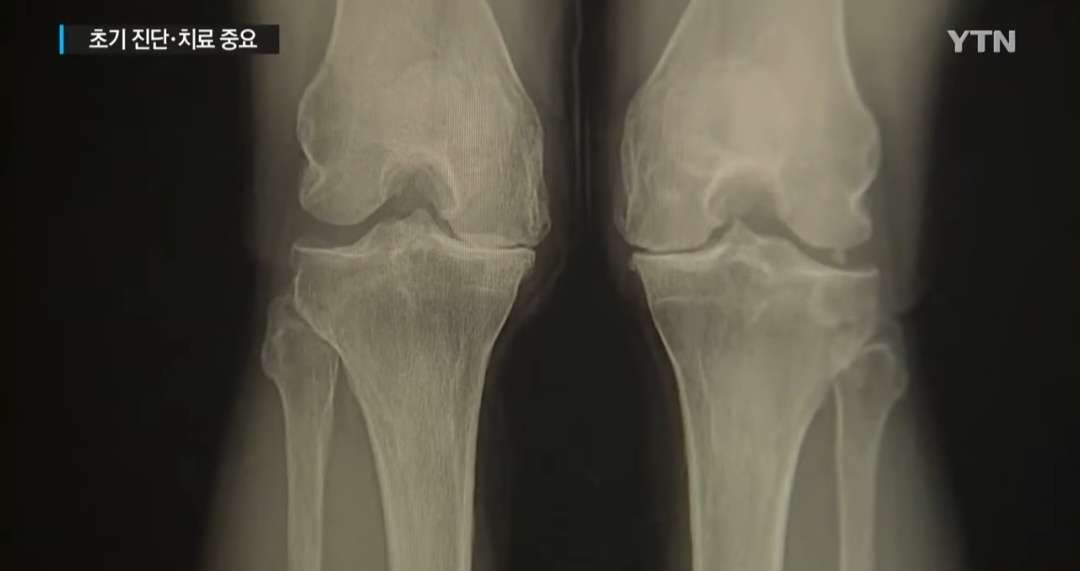 관절염 초기증상